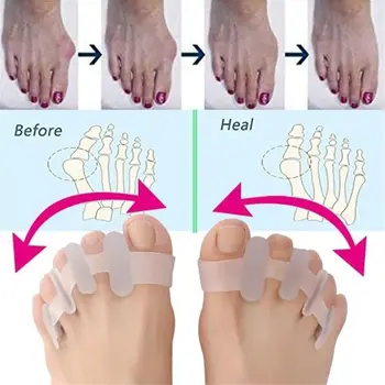 1 Pár Jednoduché Použitie Valgus Zdravotnej Starostlivosti Priložte Prsty Orthotics Starostlivosť O Nohy Nástroje Silikónové Prst Oddeľovač Bunion Corrector